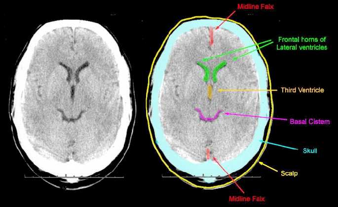 ct scan of head how long does it take